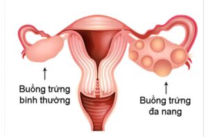 Hội Chứng Buồng Trứng Đa Nang và Giải Pháp IVF cho Vô Sinh