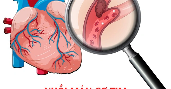 Nhận Diện và Cấp Cứu Nhồi Máu Cơ Tim Qua Triệu Chứng Đau Vùng Bụng