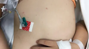 Tăng Ca Nhiễm Bệnh Não Mô Cầu Ở Khu Vực Phía Nam